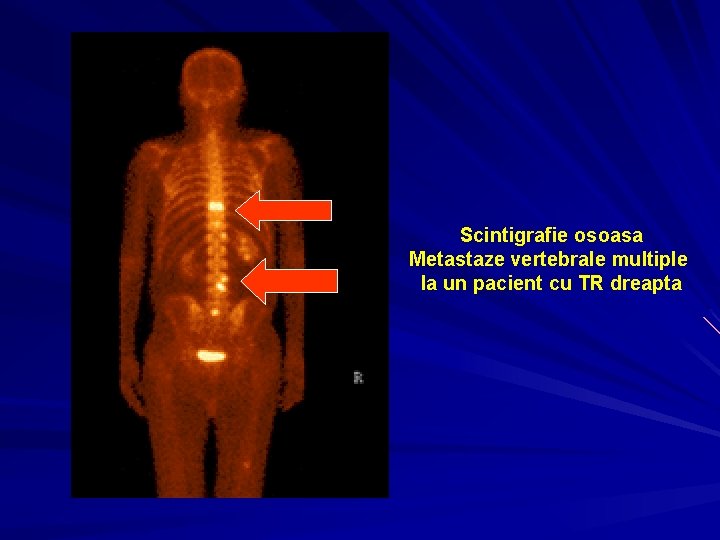 Scintigrafie osoasa Metastaze vertebrale multiple la un pacient cu TR dreapta 