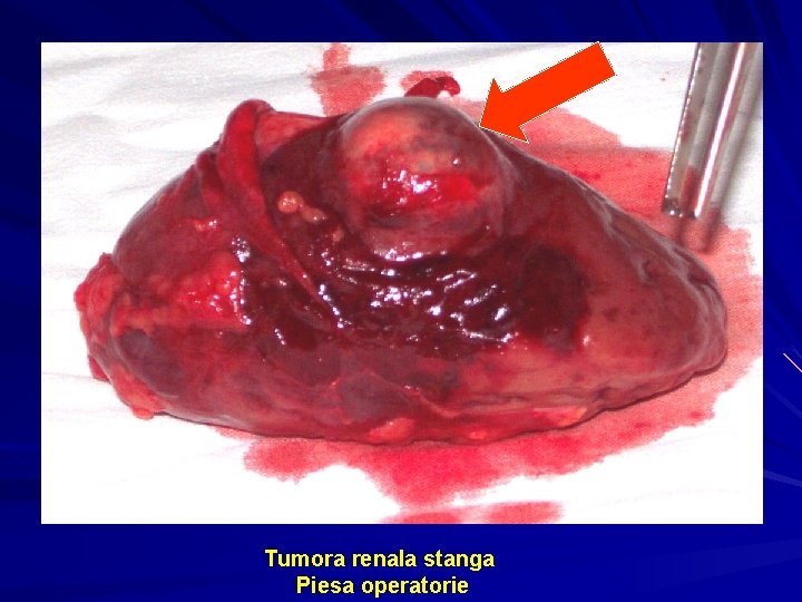 Tumora renala stanga Piesa operatorie 
