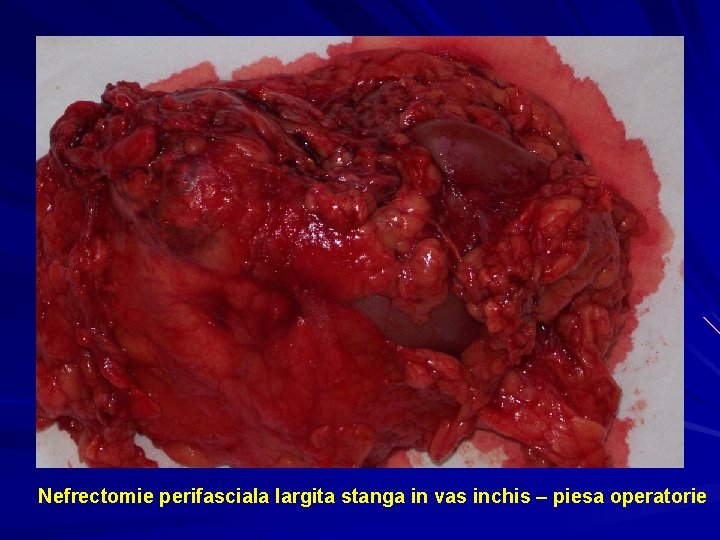 Nefrectomie perifasciala largita stanga in vas inchis – piesa operatorie 