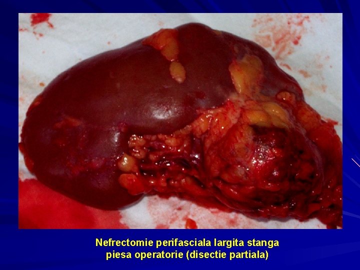 Nefrectomie perifasciala largita stanga piesa operatorie (disectie partiala) 