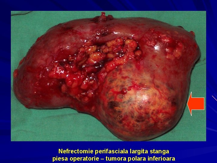 Nefrectomie perifasciala largita stanga piesa operatorie – tumora polara inferioara 