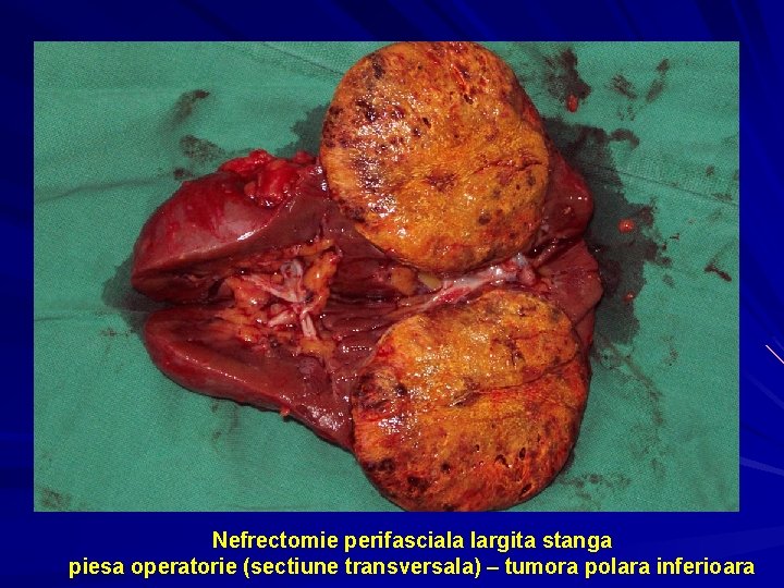 Nefrectomie perifasciala largita stanga piesa operatorie (sectiune transversala) – tumora polara inferioara 