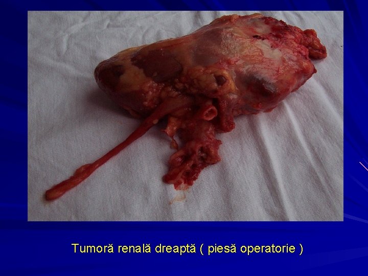 Tumoră renală dreaptă ( piesă operatorie ) 