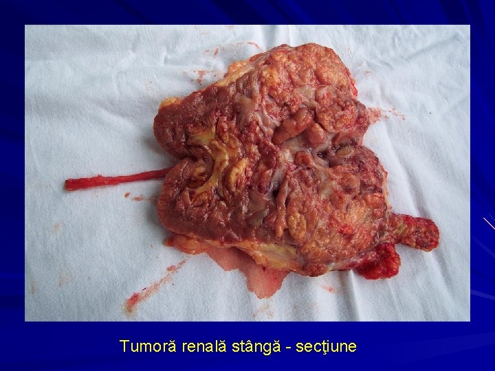 Tumoră renală stângă - secţiune 