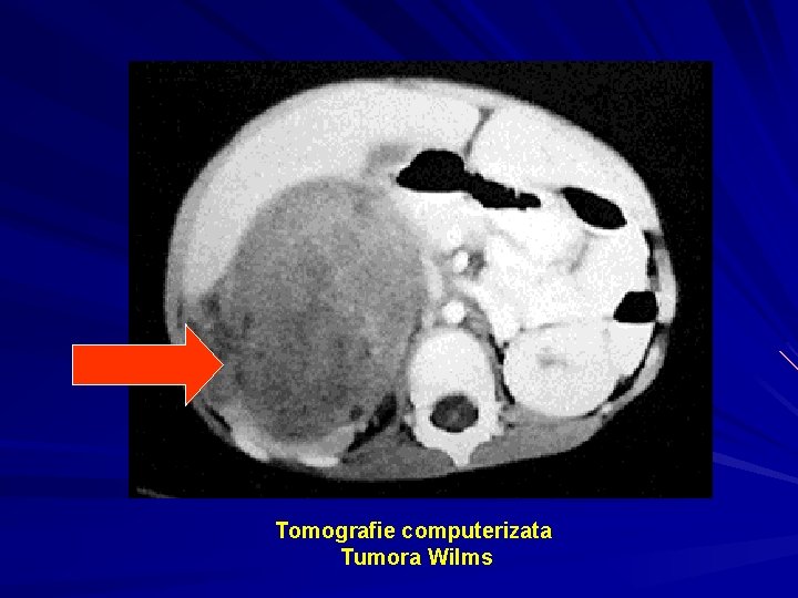 Tomografie computerizata Tumora Wilms 
