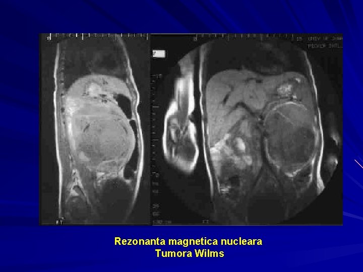 Rezonanta magnetica nucleara Tumora Wilms 