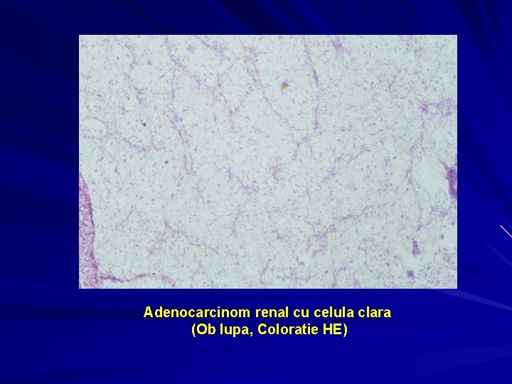Adenocarcinom renal cu celula clara (Ob lupa, Coloratie HE) 