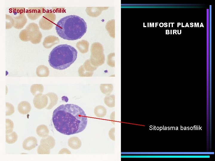 Sitoplasma basofilik LIMFOSIT PLASMA BIRU Sitoplasma basofilik 