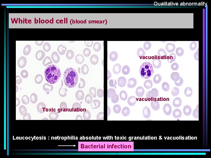 Qualitative abnormality White blood cell (blood smear) vacuolisation Toxic granulation Leucocytosis : netrophilia absolute