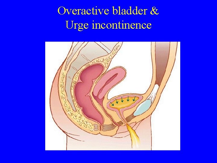 Overactive bladder & Urge incontinence 