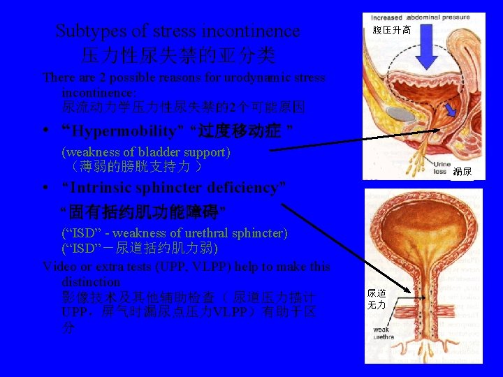 Subtypes of stress incontinence 压力性尿失禁的亚分类 腹压升高 There are 2 possible reasons for urodynamic stress