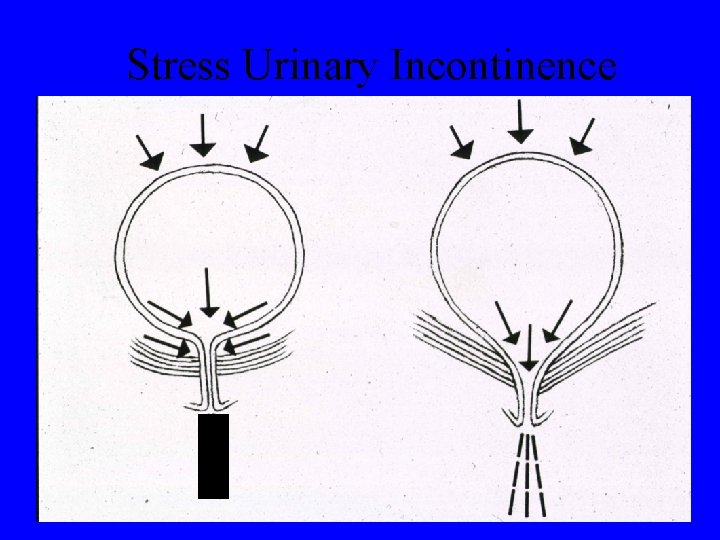 Stress Urinary Incontinence 