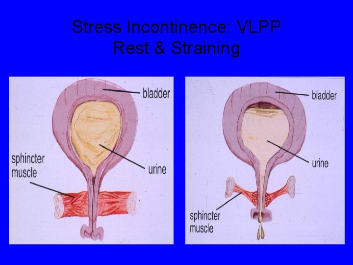 Stress Incontinence: VLPP Rest & Straining 