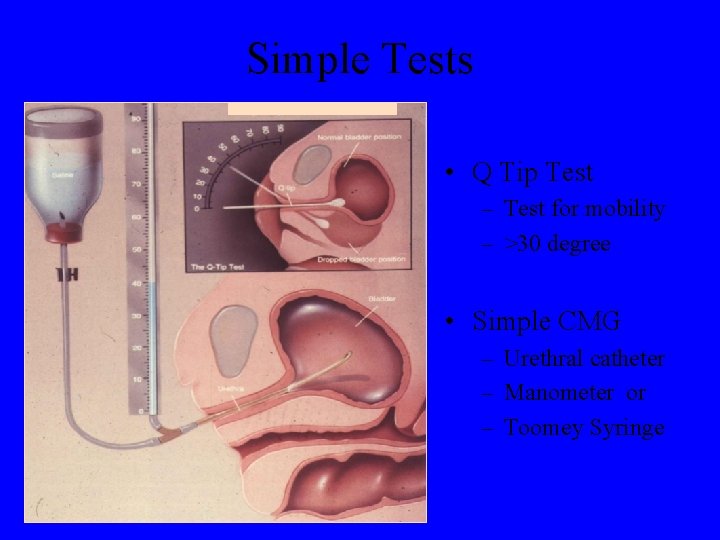 Simple Tests • Q Tip Test – Test for mobility – >30 degree •