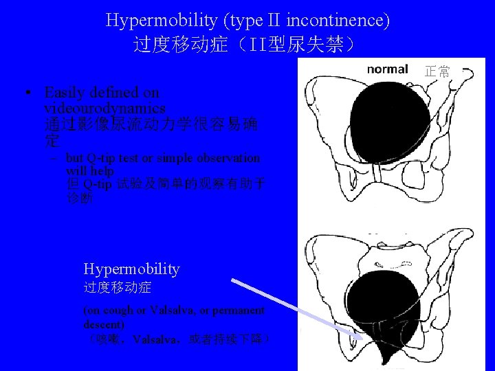 Hypermobility (type II incontinence) 过度移动症（II型尿失禁） 正常 • Easily defined on videourodynamics 通过影像尿流动力学很容易确 定 –
