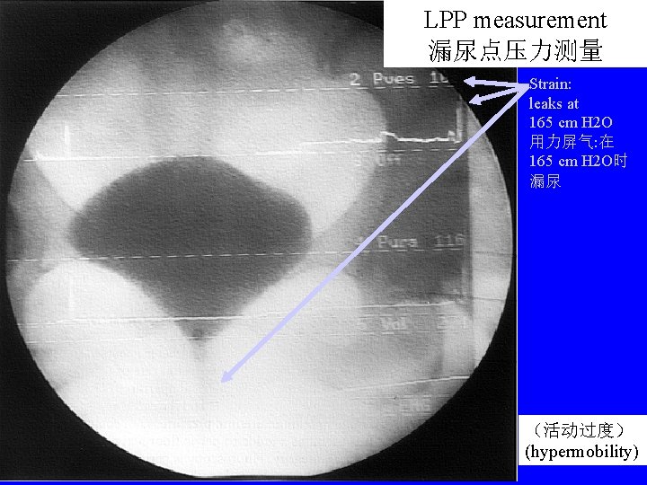 LPP measurement 漏尿点压力测量 Strain: leaks at 165 cm H 2 O 用力屏气: 在 165