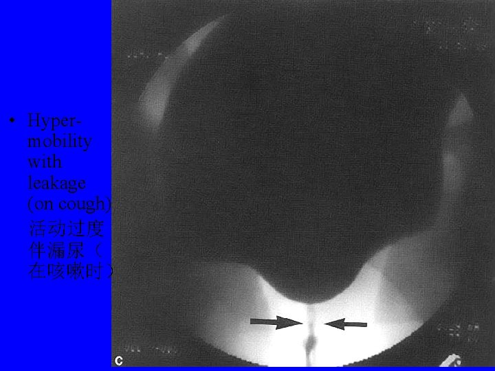  • Hypermobility with leakage (on cough) 活动过度 伴漏尿（ 在咳嗽时） 