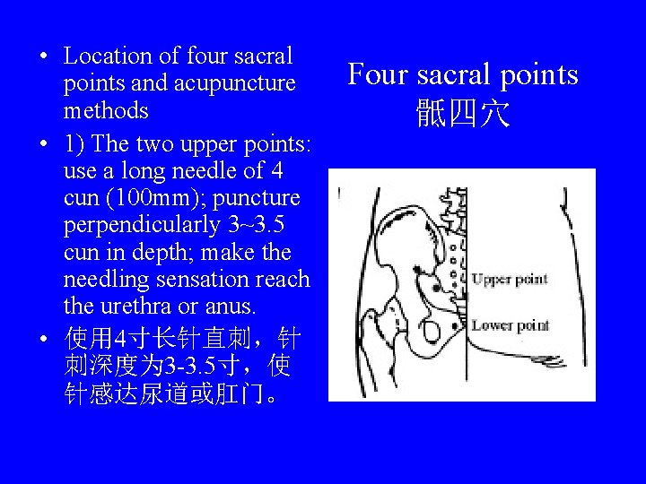  • Location of four sacral points and acupuncture methods • 1) The two