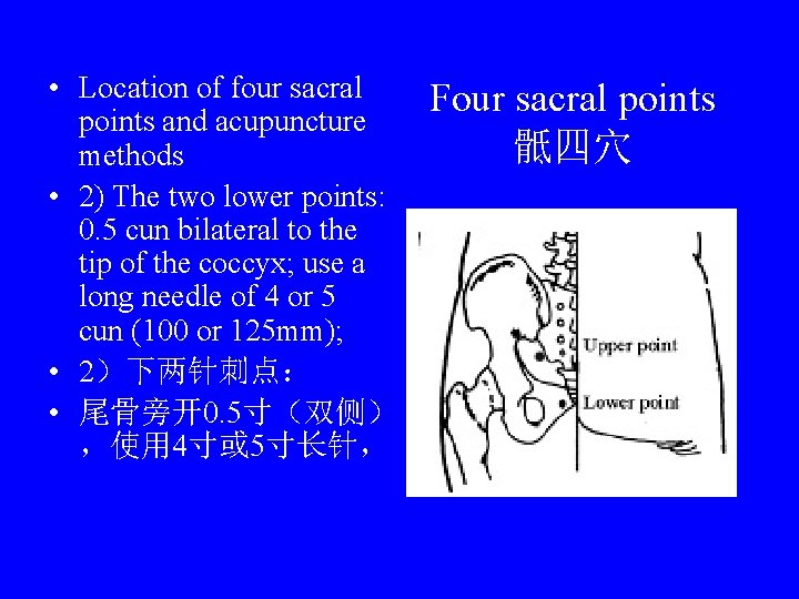  • Location of four sacral points and acupuncture methods • 2) The two