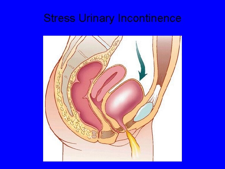 Stress Urinary Incontinence 