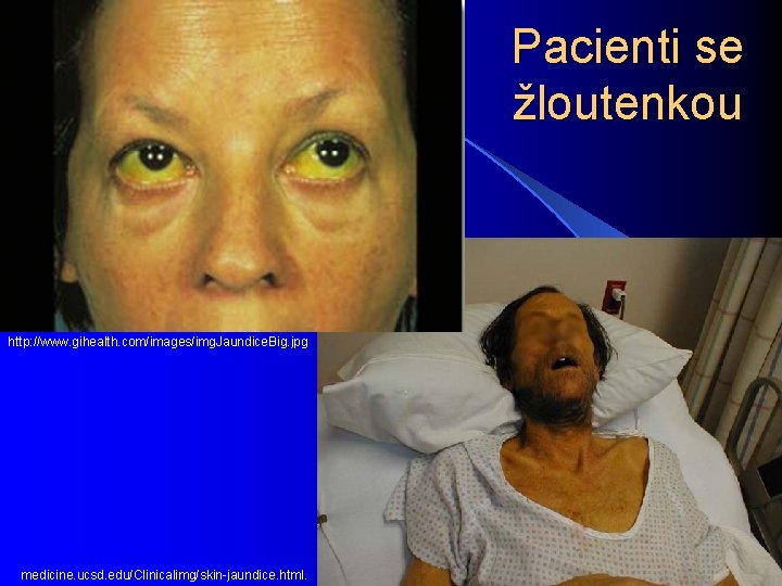 Pacienti se žloutenkou http: //www. gihealth. com/images/img. Jaundice. Big. jpg medicine. ucsd. edu/Clinicalimg/skin-jaundice. html.