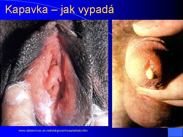 Kapavka – jak vypadá www. stdservices. on. net/std/gonorrhoea/details. htm 