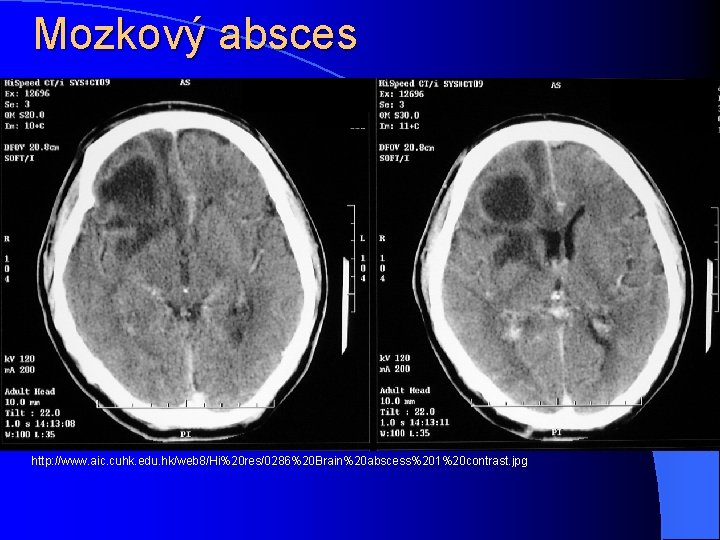 Mozkový absces http: //www. aic. cuhk. edu. hk/web 8/Hi%20 res/0286%20 Brain%20 abscess%201%20 contrast. jpg