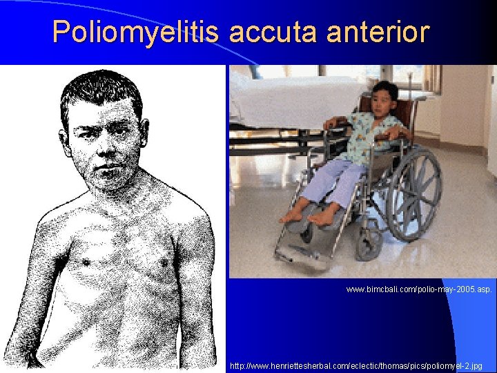 Poliomyelitis accuta anterior www. bimcbali. com/polio-may-2005. asp. http: //www. henriettesherbal. com/eclectic/thomas/pics/poliomyel-2. jpg 