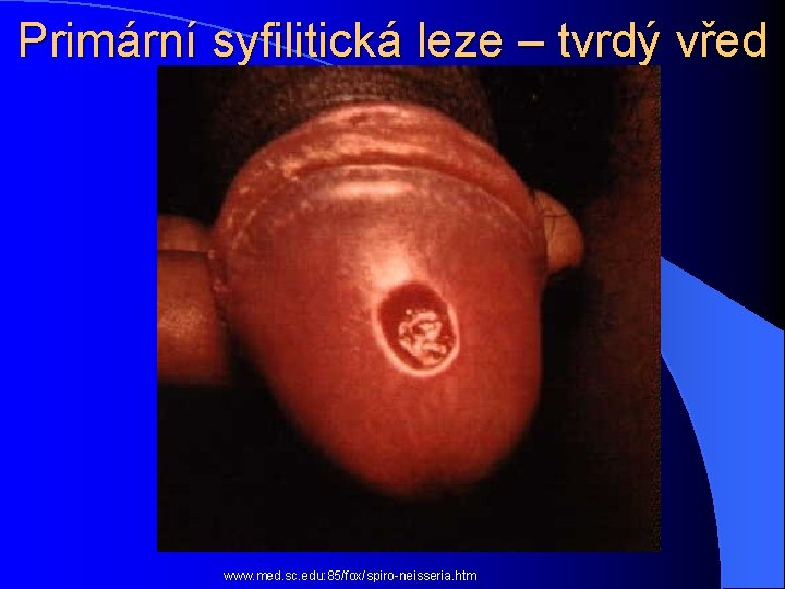 Primární syfilitická leze – tvrdý vřed www. med. sc. edu: 85/fox/spiro-neisseria. htm 