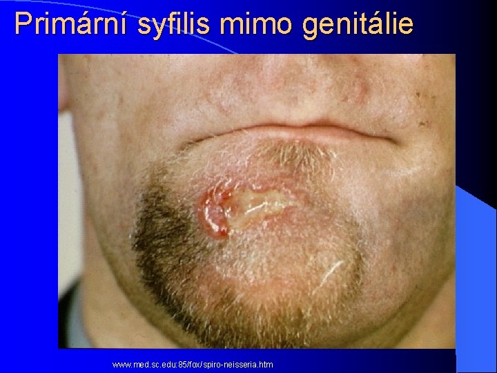 Primární syfilis mimo genitálie www. med. sc. edu: 85/fox/spiro-neisseria. htm 