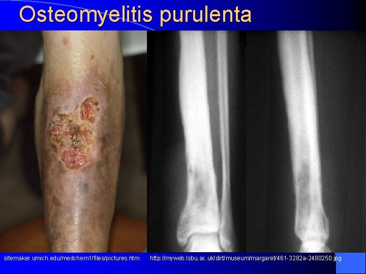 Osteomyelitis purulenta sitemaker. umich. edu/medchem 1/files/pictures. htm http: //myweb. lsbu. ac. uk/dirt/museum/margaret/461 -3282 a-2480250.