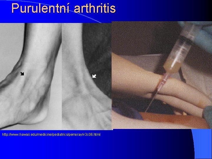 Purulentní arthritis http: //www. hawaii. edu/medicine/pediatrics/pemxray/v 3 c 06. html 