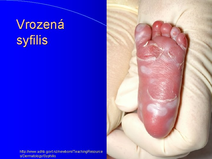 Vrozená syfilis http: //www. adhb. govt. nz/newborn/Teaching. Resource s/Dermatology/Syphilis 