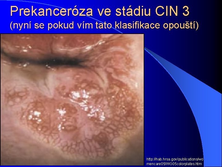 Prekanceróza ve stádiu CIN 3 (nyní se pokud vím tato klasifikace opouští) http: //hab.