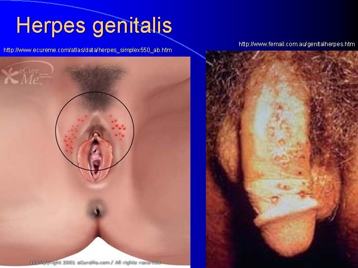 Herpes genitalis http: //www. ecureme. com/atlas/data/herpes_simplex 550_ab. htm http: //www. femail. com. au/genitalherpes. htm