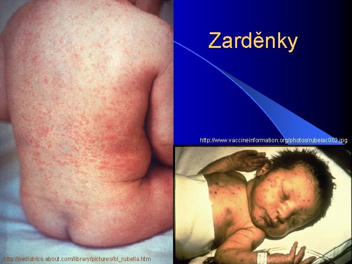 Zarděnky http: //www. vaccineinformation. org/photos/rubeiac 002. jpg http: //pediatrics. about. com/library/pictures/bl_rubella. htm 