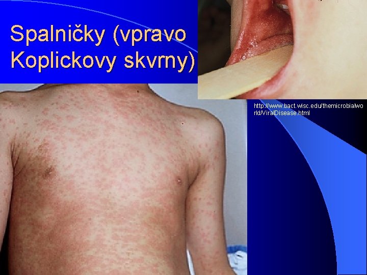 Spalničky (vpravo Koplickovy skvrny) http: //www. bact. wisc. edu/themicrobialwo rld/Viral. Disease. html 