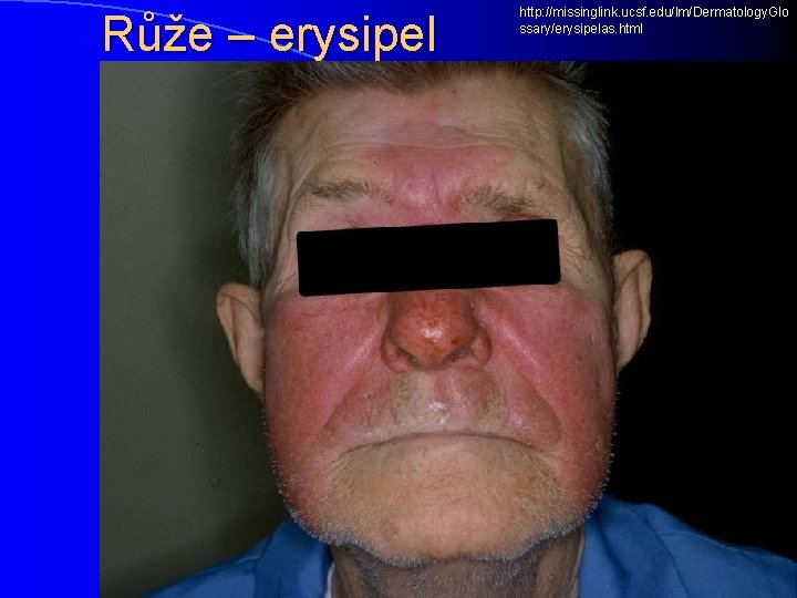 Růže – erysipel http: //missinglink. ucsf. edu/lm/Dermatology. Glo ssary/erysipelas. html 