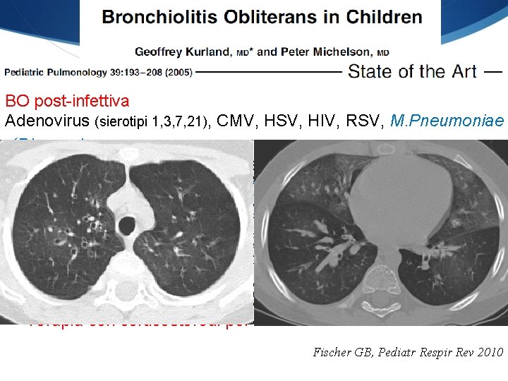 BO post-infettiva Adenovirus (sierotipi 1, 3, 7, 21), CMV, HSV, HIV, RSV, M. Pneumoniae