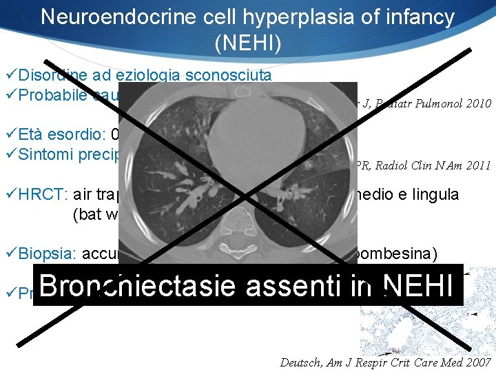 Neuroendocrine cell hyperplasia of infancy (NEHI) üDisordine ad eziologia sconosciuta üProbabile causa genetica üEtà