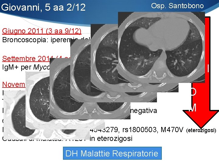 Giovanni, 5 aa 2/12 Osp. Santobono S I Settembre 2011 (4 aa) N Ig.