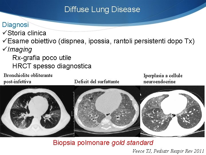 Diffuse Lung Disease Diagnosi üStoria clinica üEsame obiettivo (dispnea, ipossia, rantoli persistenti dopo Tx)