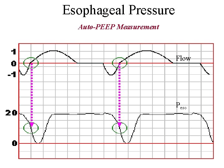 Esophageal Pressure Auto-PEEP Measurement Flow Peso 