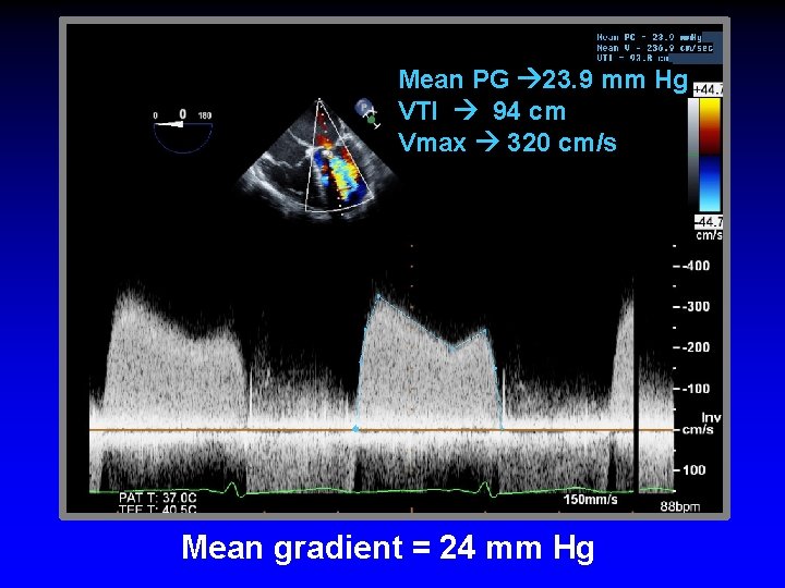 Mean PG 23. 9 mm Hg VTI 94 cm Vmax 320 cm/s Mean gradient