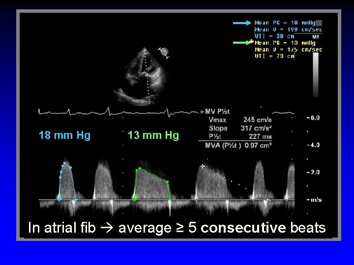 18 mm Hg 13 mm Hg In atrial fib average ≥ 5 consecutive beats