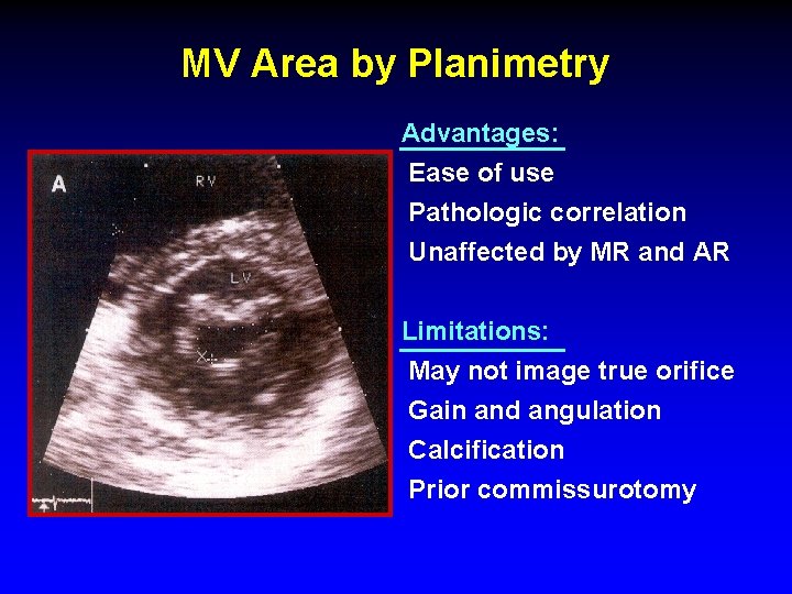 MV Area by Planimetry Advantages: Ease of use Pathologic correlation Unaffected by MR and