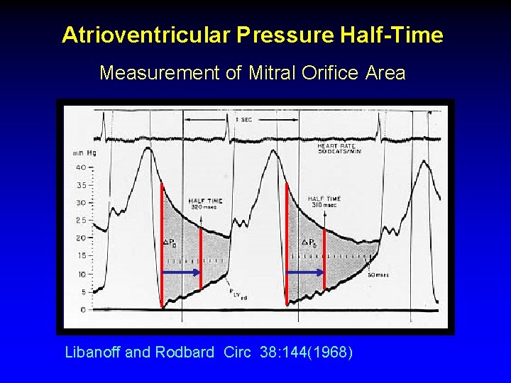 Atrioventricular Pressure Half-Time Measurement of Mitral Orifice Area Libanoff and Rodbard Circ 38: 144(1968)