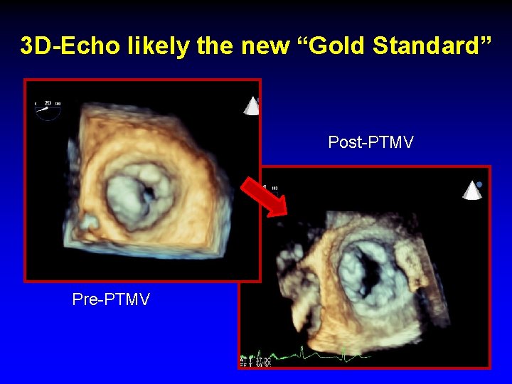 3 D-Echo likely the new “Gold Standard” Post-PTMV Pre-PTMV 