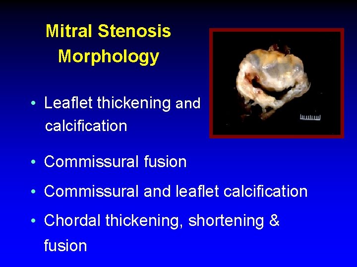 Mitral Stenosis Morphology • Leaflet thickening and calcification • Commissural fusion • Commissural and