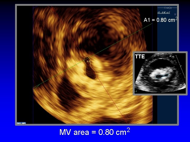 A 1 = 0. 80 cm 2 TTE MV area = 0. 80 cm